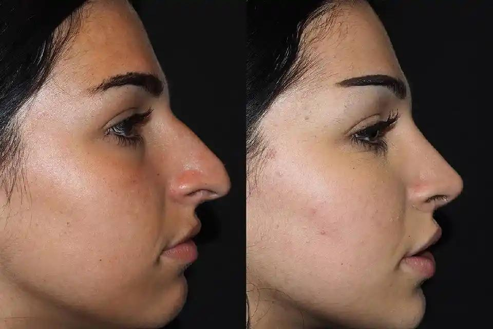 Best Seasons for Rhinoplasty in Dubai