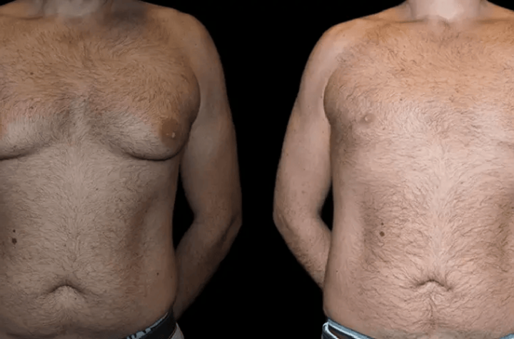 male breast reduction with before and after results