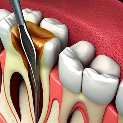 The Comprehensive Guide to Root Canal Treatment Procedures