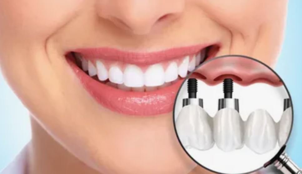 dental implants