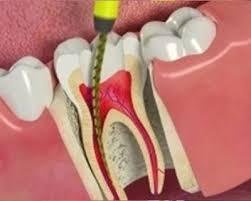 Root Canal Treatment in Noida