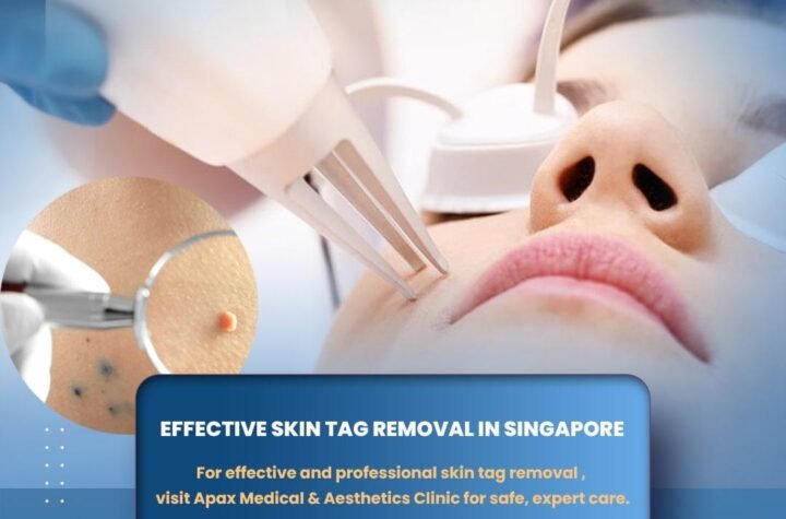 Skin tag removal Singapore