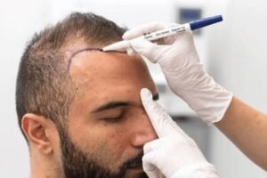 Hair transplant in Islamabad